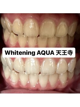 アクア 天王寺店(AQUA)/セルフホワイトニング/天王寺