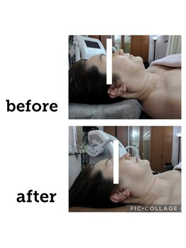 クリオネ(Clione)/BBL光フェイシャル 効果5倍