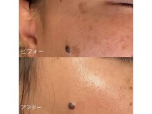 ラエッセ 恵比寿(LAESSE)/毛穴・美白専門店 LAESSE 恵比寿