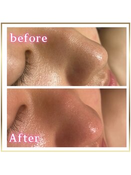 ピュアスキンサロン 恵比寿店(pure skin salon)/毛穴洗浄 ハイドラフェイシャル
