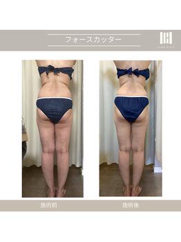 カリスボーテ 関本店/フォースカッター