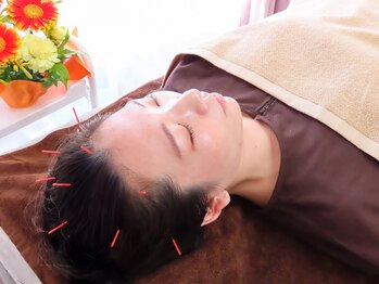 アカリコ鍼灸(Akariko鍼灸)/頭に鍼をうっていきます