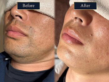 グラスト(Grast)/ヒゲ脱毛・青ひげ改善