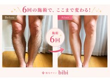 ビビ(bibi)/メンズ足脱毛施術6回