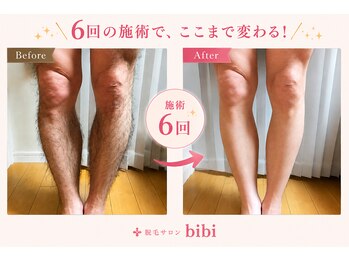 ビビ(bibi)/メンズ足脱毛施術6回