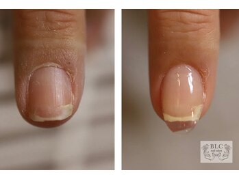 ビーエルシー ネイルサロン(BLC nail salon)/爪のコンプレックス解消