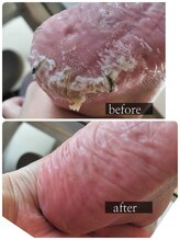 シーエスネイル 元住吉店(CS NAIL)/足裏角質ケアコース♪