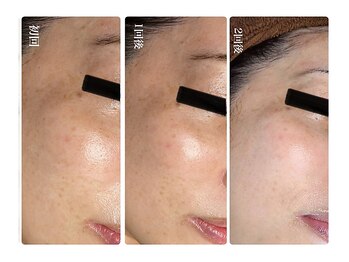 キレイ(KIREI)/初回→1回後→2回後