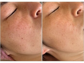 ナンバーナイン(No.9)/ピグメンテーションデトックス