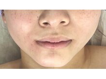 クラリティ(CLARITY)/１番人気の小顔エステ