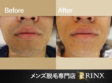 リンクス 神戸本店(RINX)/ヒゲ脱毛《メンズ脱毛RINX》