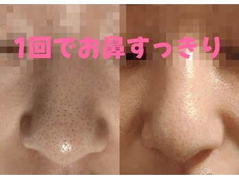 藍/ピーリング＆プラズマ