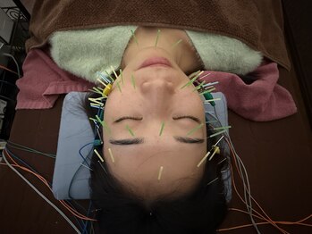 チャチャエイム整骨院 鍼灸院/美容鍼でリフレッシュ