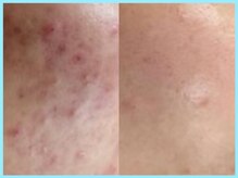 ヴィオール 名古屋栄店(VIOR)/ニキビ改善