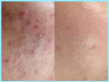 ヴィオール 名古屋栄店(VIOR)/ニキビ改善