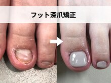 ブルームーンネイルズ(BLOOMOON.nails)/フット深爪矯正