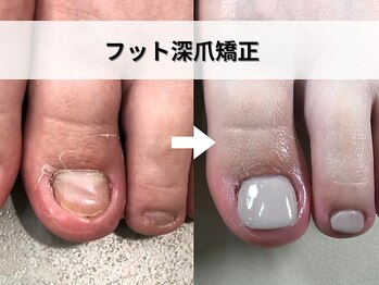 ブルームーンネイルズ(BLOOMOON.nails)/フット深爪矯正