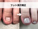 フット深爪矯正