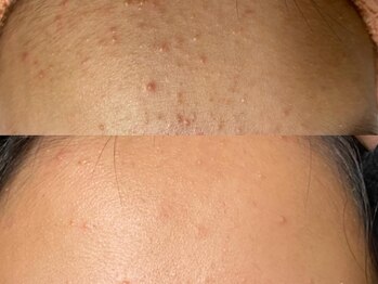 アイラッシュ ラピス(Lapis)/フェイシャル/毛穴悩み/小顔