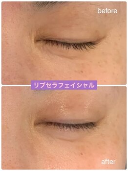 プリュネル(Prunelle)/プラズマシャワー