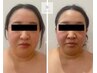 【小顔人気No1】1day小顔脂肪燃焼剤導入×EMS×炭酸ガスパック