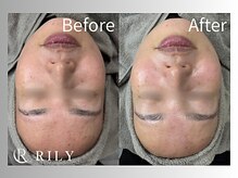 リリー(RILY)/【プラズマビフォーアフター】