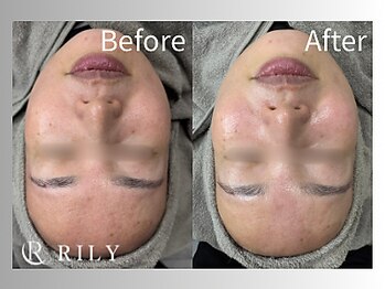 リリー(RILY)/【プラズマビフォーアフター】