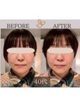 チョコバリ 錦糸町店(chocobari)/小顔×リフトアップ(美容鍼)40代