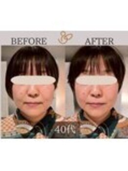 チョコバリ 錦糸町店(chocobari)/小顔×リフトアップ(美容鍼)40代