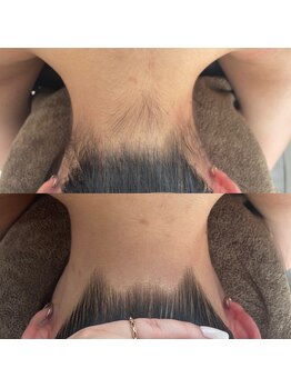 ミース 北九州店/脱毛1回目から驚くほどスッキリ!