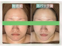 サロン ド メタセコイア(salon de Metasequoia)/【マシン施術前】before／after