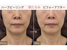マロン(MARON)の雰囲気(ハーブピーリング/ たるみ/毛穴/肌質改善)
