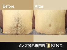 リンクス 神戸本店(RINX)/ボディ脱毛《メンズ脱毛RINX》