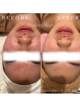 フローレ 平針店(Flore)/20代のニキビケアにオススメ