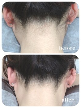 エタニティ 西宮店(Eternity)/うなじ・背中脱毛