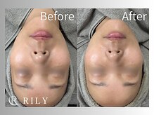 リリー(RILY)/【プラズマビフォーアフター】