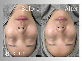 リリー(RILY)/【プラズマビフォーアフター】