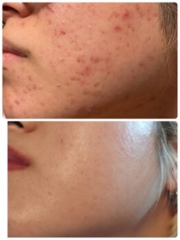 美プラス/《20代》ピーリング×スキンケア