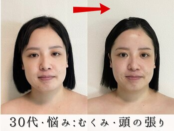 ジョンミー(JONMEE)/小顔矯正で頭皮からリフトアップ