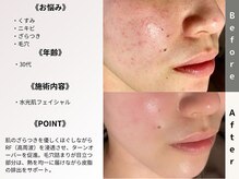 ルディラ 町田店/水光肌フェイシャル