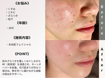 ルディラ 町田店/水光肌フェイシャル