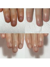 セラキュアネイル(Theracure nail)/ネイルNGのお客様の深爪緩和