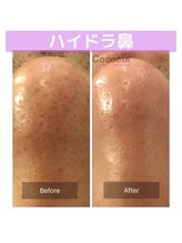 ココシア 取手店(COCOCIA)/毛穴洗浄トリートメント症例★