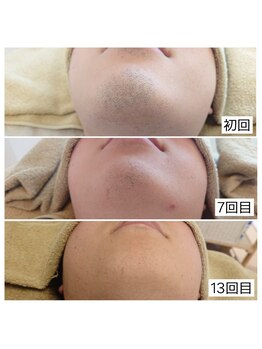 ロココ 山口店(Lococo)/【メンズ】ヒゲ脱毛経過