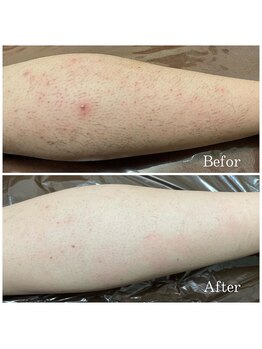 フォルチェ ゆめタウン広島店(Folche)/メンズ足脱毛!