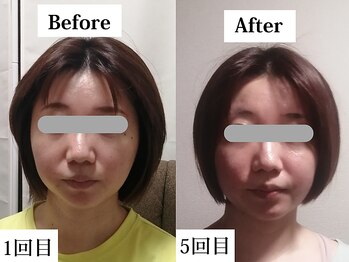 慧仁治療院/食いしばり改善/エラ 顔の歪み