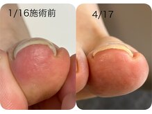 ロンディネ(Rondine)/巻き爪ケア&ネイルトリム30