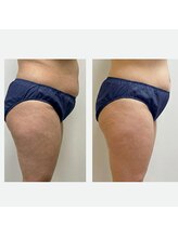 レポリア(Reporia)/キャビテーションBeforeAfter