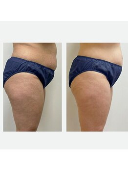 レポリア(Reporia)/キャビテーションBeforeAfter