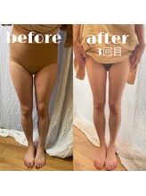 リリーボーテ 下北沢/インディバ施術（下半身）